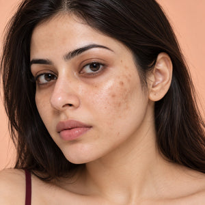Hyperpigmentation